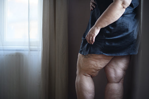 Lipoedème aux jambes : symptômes, traitement avec la pressothérapie